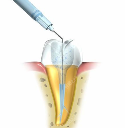 牙齿漏神经疼该怎么办？可根管治疗改善