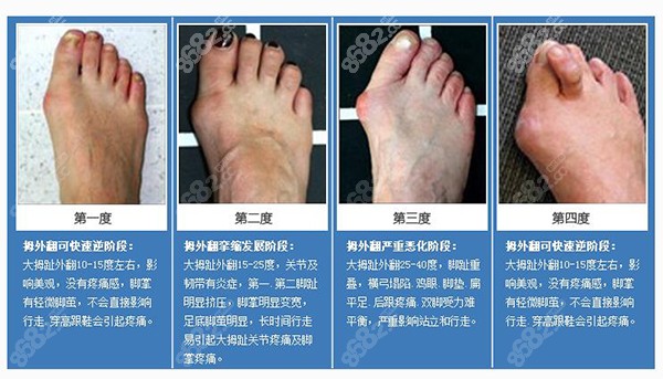 拇外翻四个阶段的图片