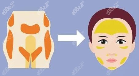 青岛华韩脂肪填充示意图