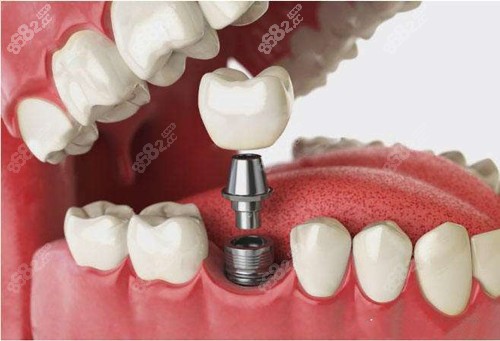 www.8682.cc武汉汉阳牙科医院种植牙价格参考