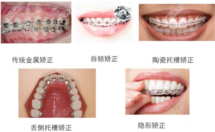 福清牙齿矫正价格表 福清牙齿矫正价格表