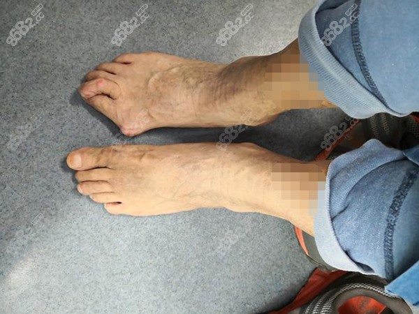 大脚骨拇外翻