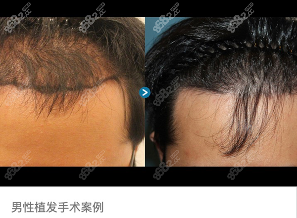 韩国毛杰琳男性毛发移植中心例子8682.cc