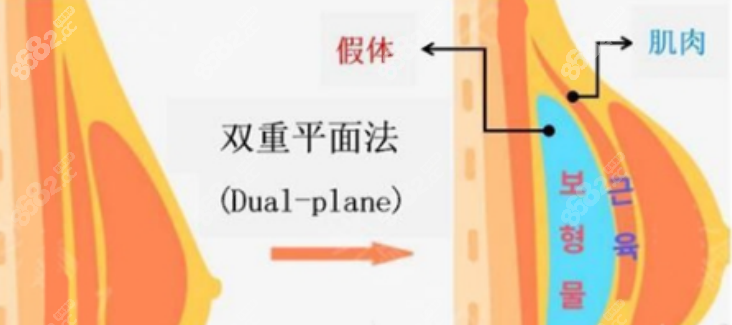 深圳隆胸