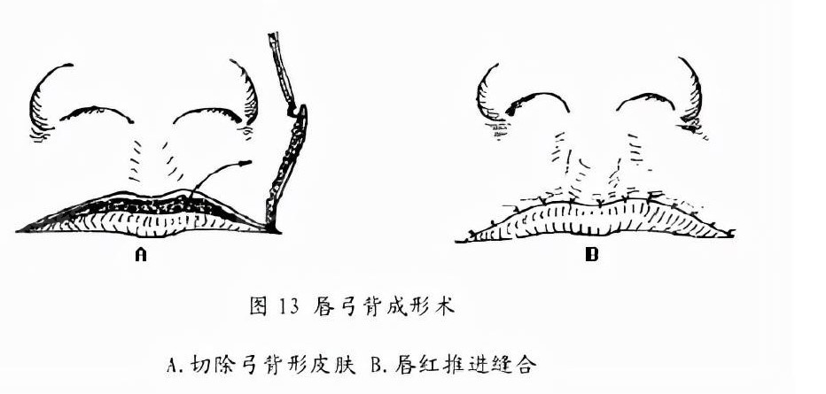 8682网分享广州高尚做唇裂修复技术特色
