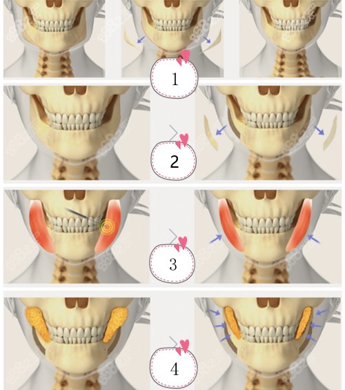 四合一下颌轮廓手术步骤图8682.cc
