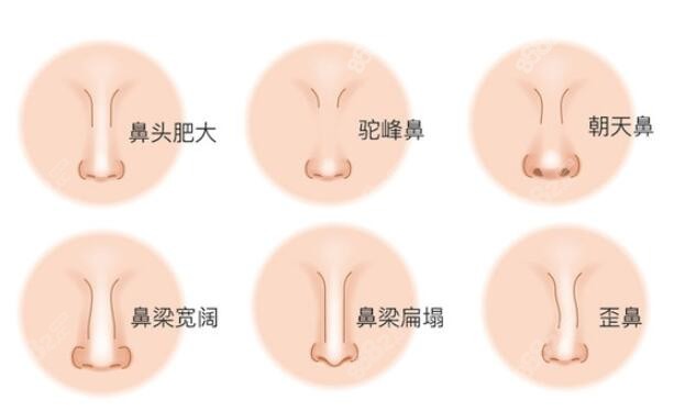 韩国新帝瑞娜整形医院整鼻子类型多8682.cc