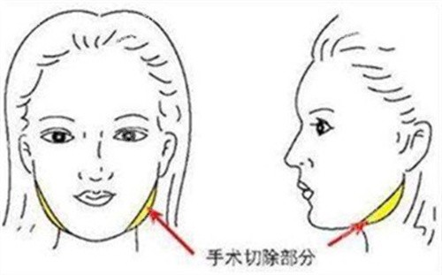 成都友谊医院磨骨手术价格贵吗？