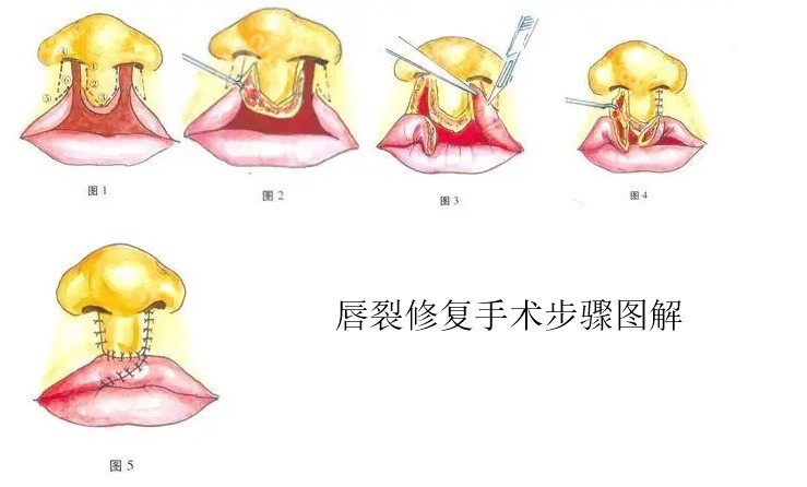 唇裂修复手术步骤图解8682.cc