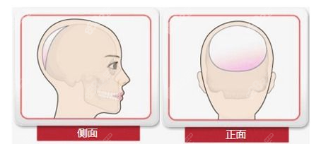 骨水泥填充后脑勺结果不错（m.8682.cc）