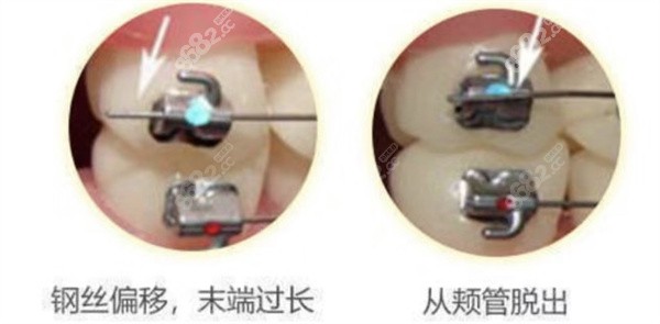 矫正出现托槽脱落，刮嘴怎么办