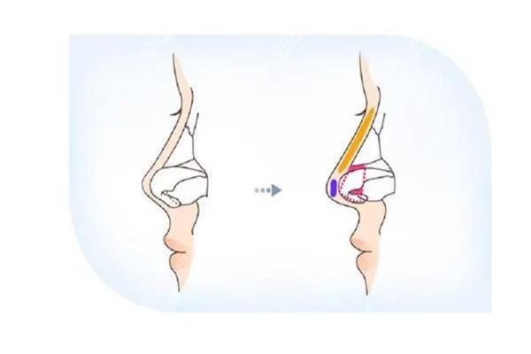 廣州隆鼻哪家好