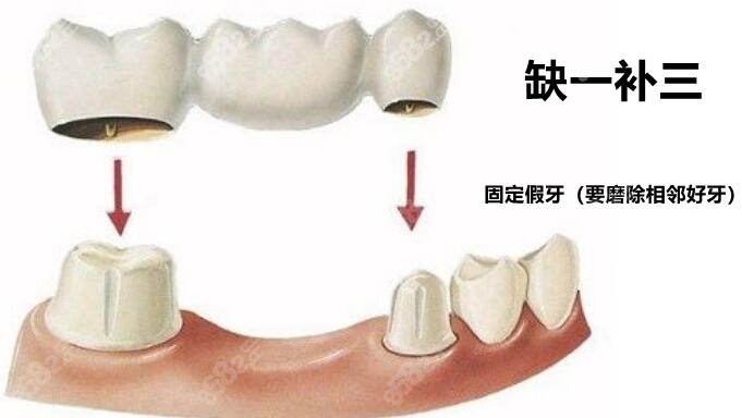 镶一颗牙就需要付三颗牙的钱吗