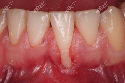牙肉萎缩方法图片