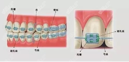 怎么选择托槽Roth和MBT