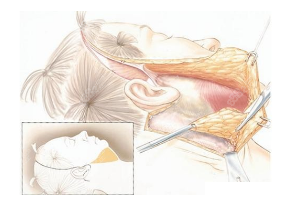 拉皮手术剥离示意图8682.cc