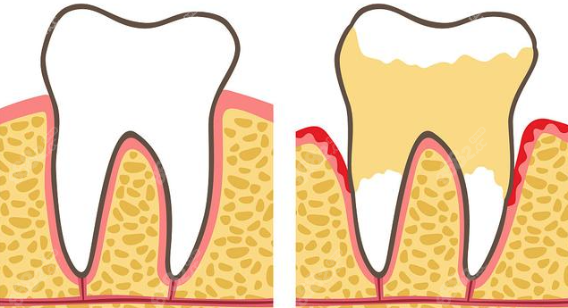 正常牙龈和萎缩牙龈区别图