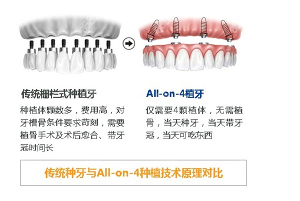 传统种植牙和all on 4种植牙的对比