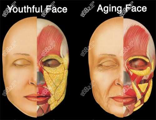 液态提升脸部可以维持多久？
