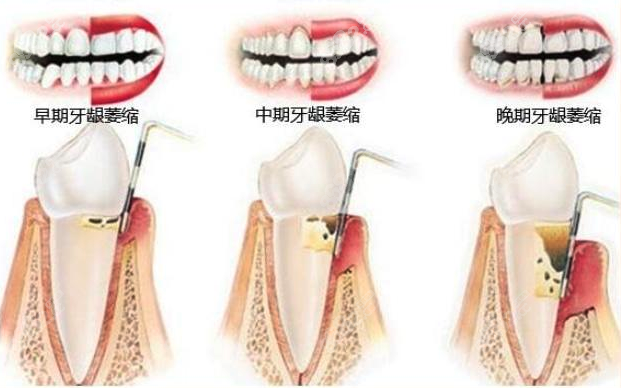 牙龈萎缩和正常牙龈图片对比www.8682.cc