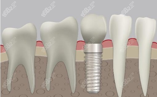拔牙后可以马上种植牙吗