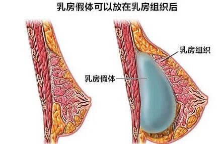 张林宏隆胸怎么样