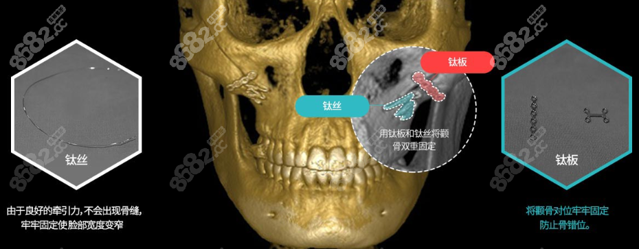 韩国ts整形医院颧骨内推双固定技术