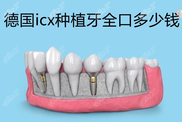 德国icx种植牙全口多少钱