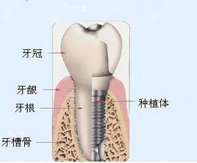 种植牙的结构
