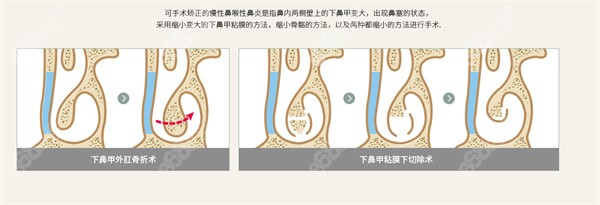 鼻炎手术