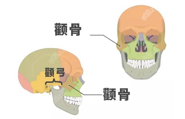 什么是颧骨缩小术