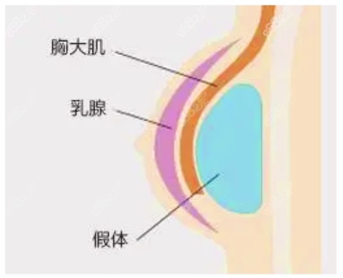 曾昂医生做隆胸技术扎实