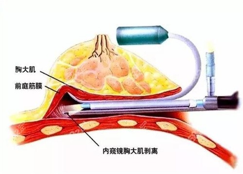 双平面隆胸示意图