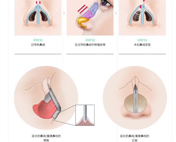 鼻阀重建术