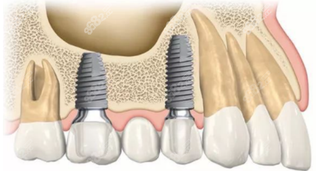 口腔医院种植牙