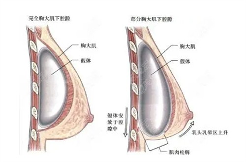 王明利医生做隆胸技术精良