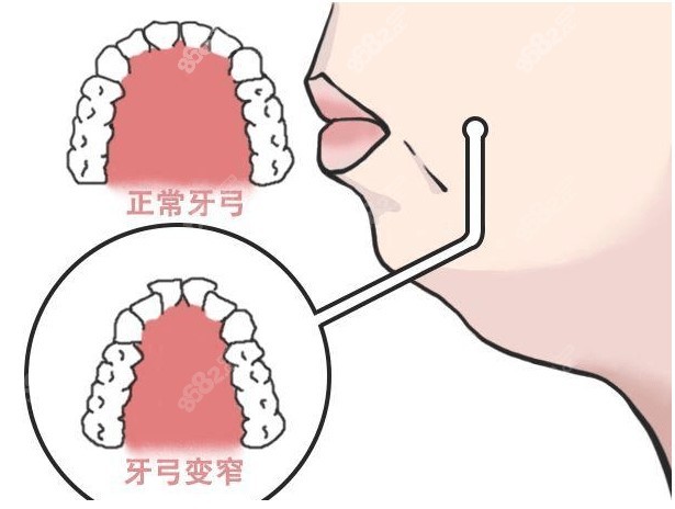 深覆合一定要做矫正吗？