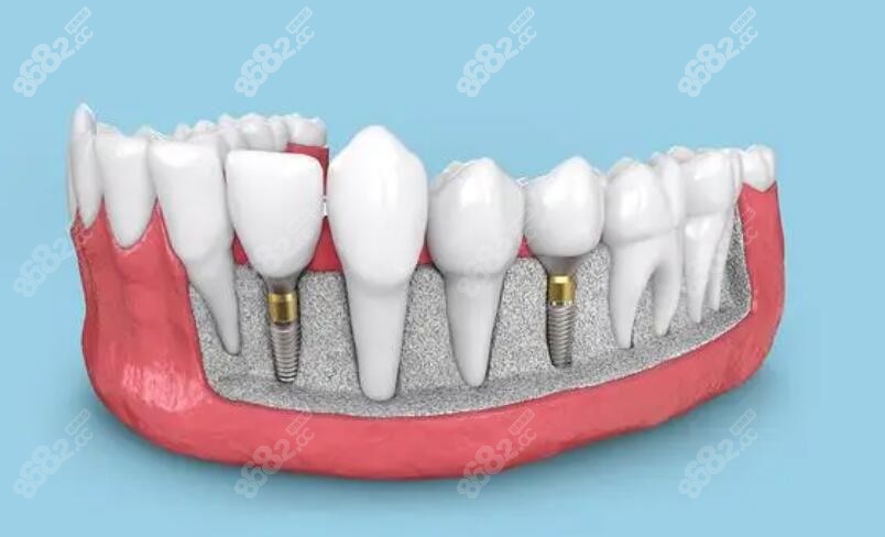 前门牙种植示意图www.8682.cc