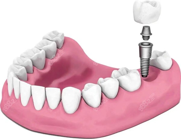 忻州恒伦口腔做种植牙的原理图