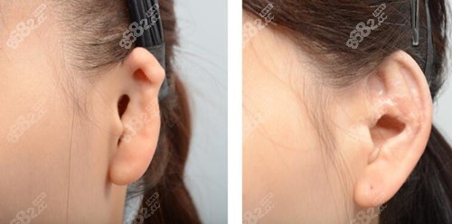 韩国普罗菲耳profile整形外科耳再造真人实例