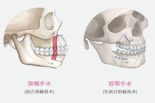 正颌手术