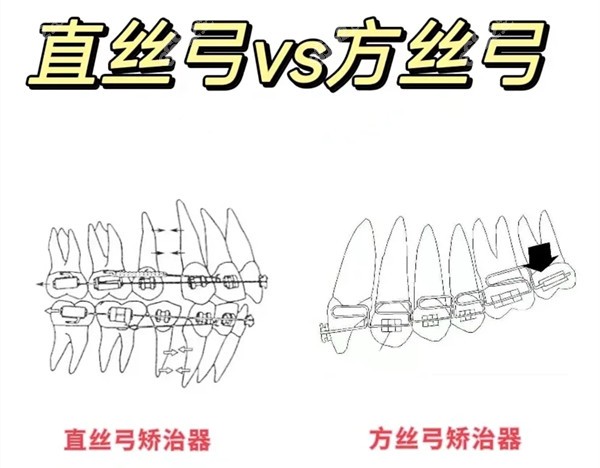 普通型的牙弓丝的分类和作用