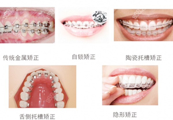 各类牙齿矫正器的图