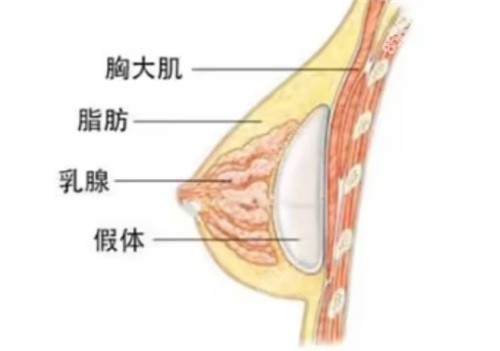 韩国医院做假体隆胸术前注意事项