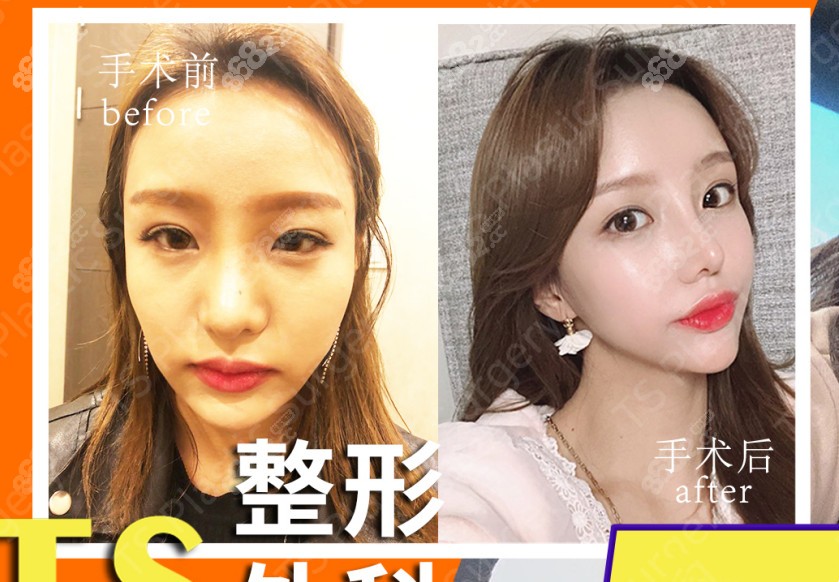 韩国ts整形鼻修复术后6个月对比照