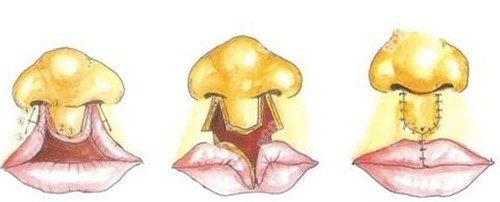 北京唇裂修复医院排名榜