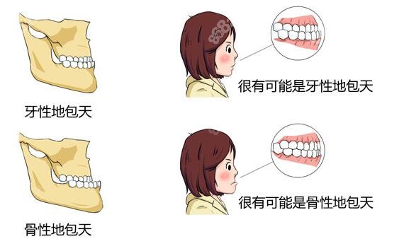 对齿和地包天的区别图片