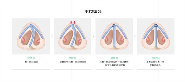 鼻中隔弯曲症矫正术