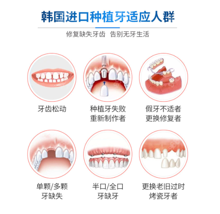 <!--<i data=20240705-sp></i>-->口腔种植牙怎么样