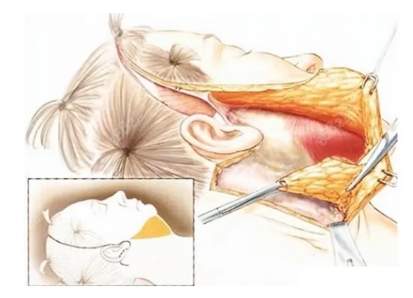 北京华韩高亚东拉皮手术示意图
